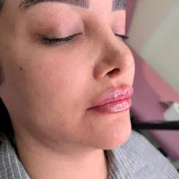 مطب تزریق ژل لب تخفیف فیلر لیفت صورت بوتاکس