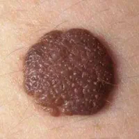 برداشتن خال