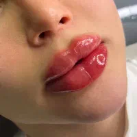 تزریق لب روسی/فیلر بادی/بوتاکس/مزوژل/prp|خدمات آرایشگری و زیبایی|تهران, تهرانپارس غربی|دیوار