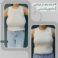 ماموپلاستی درمانی(کاهشی)