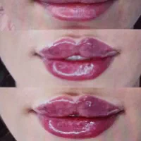 تزریق ژل و فیلر