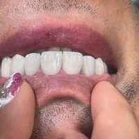 جشنواره کامپوزیت،لمینیت وبلیچینگ وخدمات دندانپزشکی|خدمات آرایشگری و زیبایی|شاهین‌شهر, مخابرات (شهید بهشتی)|دیوار