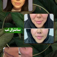 بلفارو/غبغب/سانترال/چشم گربه ایی/فیلر بادی و بکینی|خدمات آرایشگری و زیبایی|اهواز, کیانپارس |دیوار