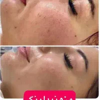 از بین بردن جای جوش و لک ،به روش مزونیدلینگ|خدمات آرایشگری و زیبایی|شیراز, معالی‌آباد|دیوار