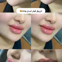 تزریق ژل و بوتاکس و پی ارپی و مزوتراپی و لیزر مو|خدمات آرایشگری و زیبایی|بوشهر, |دیوار