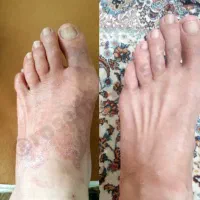 پماد گیاهی پسوریازیس