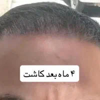 کاشت مو/PRP/ مزوتراپی