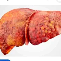 پاکسازی و سم زدایی کبد چرب