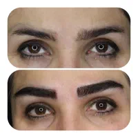 کاشت مو کاشت ابرو بلفاروپلاستی