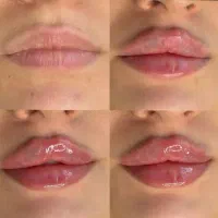 لیزر کل بدن ۴۴۰ تخفیف فیلر بوتاکس پزشک مزوprp۷۹۰