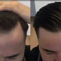 تکنسین و دستیار کاشت ابرو و مو|استخدام درمانی، زیبایی، بهداشتی|تهران, باغ فیض|دیوار