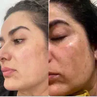 درمان لک صورت