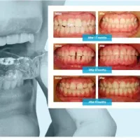 ارتودنسی شفاف(الاینر)لبخندزیبابدون سیم وبراکت|خدمات آرایشگری و زیبایی|گرگان, |دیوار