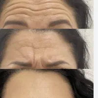 تخفیفات بزرگژل وبوتاکس در مشهد|خدمات آرایشگری و زیبایی|مشهد, کوثر|دیوار