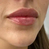 خدمات زیبایی ژل و بوتاکس