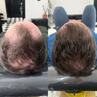 توقف ریزی مو شروع رشد دوباره