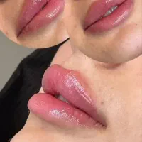 فیلرچانه ولب تزریق ژل لیزرمادلینگ پزشک|خدمات زیبایی و سلامت|تهران, صادقیه|دیوار