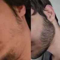 رویش ریش و سبیل