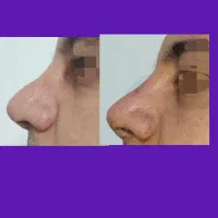 اصلاح فرم بینی بدون جراحی