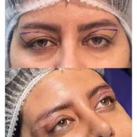جشنواره بلفاروپلاستی + لیفت ودایرکت ابرو لیزری
