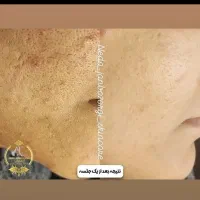 فیشال و پاکسازی پوست زیر نظر متخصص پوست|خدمات آرایشگری و زیبایی|رشت, بوسار|دیوار