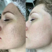 کربن تراپی ،پیلینگ هالیوودی،ریمو تتو صورت و بدن|خدمات آرایشگری و زیبایی|شیراز, فرهنگ شهر|دیوار
