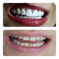 کامپوزیت دندان کامپوزیت زیبایی ونیر|خدمات آرایشگری و زیبایی|قم, چهار امامزاده|دیوار