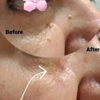 خالبرداری .رفع گوشت اضافه وچربی صورت وبدن