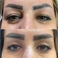 بلفاروپلاستی پلک ساکشن غبغب ژل بوتاکس سانترال لب