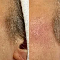 برداشت انواع خال،جوش،لک،کک و‌مک وضایعات پوستی|خدمات آرایشگری و زیبایی|تهران, سنائی|دیوار