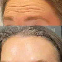 ژل فیلر بوتاکس مزو هایفو لیزر نخ|خدمات آرایشگری و زیبایی|اسلام‌شهر, باغ فیض|دیوار