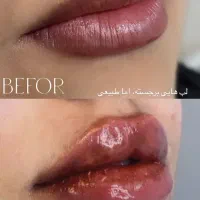 تخصص در بوتاکس و فیلر و جوانسازی|خدمات آرایشگری و زیبایی|شیراز, بعثت|دیوار