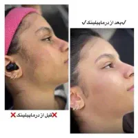 اصلاح صورت + درماپلنینگ + آبرسانی تخصصی