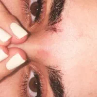 کاشت مژه