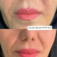 تخفیفات خدمات فیلر و بوتاکس کلینیک|خدمات آرایشگری و زیبایی|شاهین‌شهر, فردوسی|دیوار
