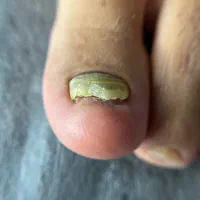 فرورفتگی ناخن توگوشت|آرایشی، بهداشتی، درمانی|انار, |دیوار