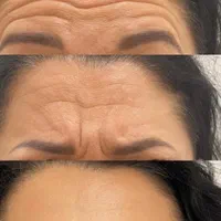 تزریق ژل و بوتاکس|خدمات آرایشگری و زیبایی|اصفهان, سنبلستان|دیوار