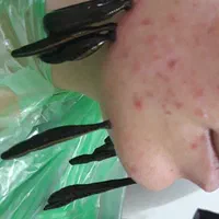 حجامت،فصدخون،زالو درمانی،طب سنتی|خدمات آرایشگری و زیبایی|تهران, تهرانسر شمالی|دیوار