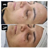 پاکسازی پوست،اموزش تخصصی،رفع تیرگی بدن