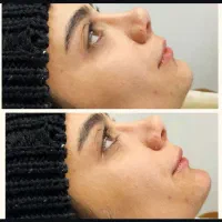 جشنواره تخفیفات ژل و بوتاکس|خدمات آرایشگری و زیبایی|نجف‌آباد, امام خمینی|دیوار