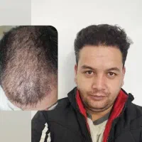 تکنسین تهرانی کاشت مو و کاشت ابرو در کرمانشاه|خدمات زیبایی و سلامت|کرمانشاه, |دیوار