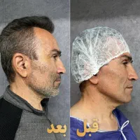 تزریق چربی صورت گندم