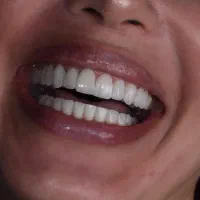 مرکز دندانپزشکی زیبایی کامپوزیت/ایمپلنت
