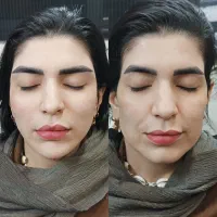 لیفتینگ پوست در یک جلسه .ژل.بوتاکس.