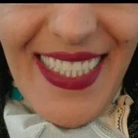 دندانسازی بابک طرح لبخند زیبا دندان|خدمات آرایشگری و زیبایی|اسفراین, |دیوار