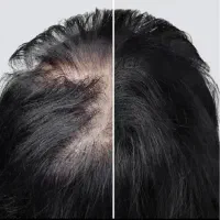 کلینیک پی ار پی ،پی اراف،مزو، نخ