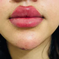 تزریق ژل لب و بوتاکس وکاشت ناخن