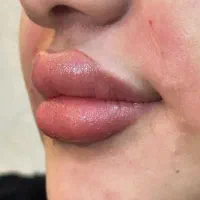 فیلر/بوتاکس /مزوتراپی/ جوانسازی