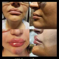 تزریق ژل و بوتاکس و انزیم و مزوجوانساز.|خدمات آرایشگری و زیبایی|پاکدشت, شهرک امام رضا|دیوار