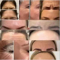 ژل لب/گونه/بوتاکس/فیلربینی/مزوپی ار پی|خدمات آرایشگری و زیبایی|مشهد, سجاد شهر|دیوار